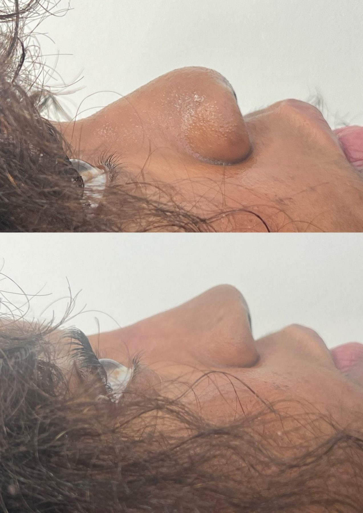 Dermal Fillers Dermal Fillers