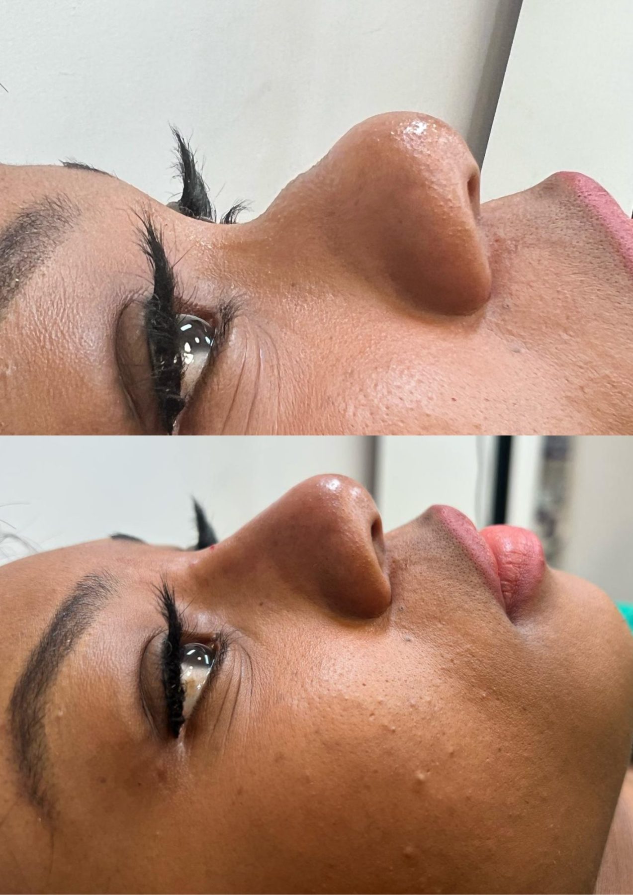 Dermal Fillers Dermal Fillers