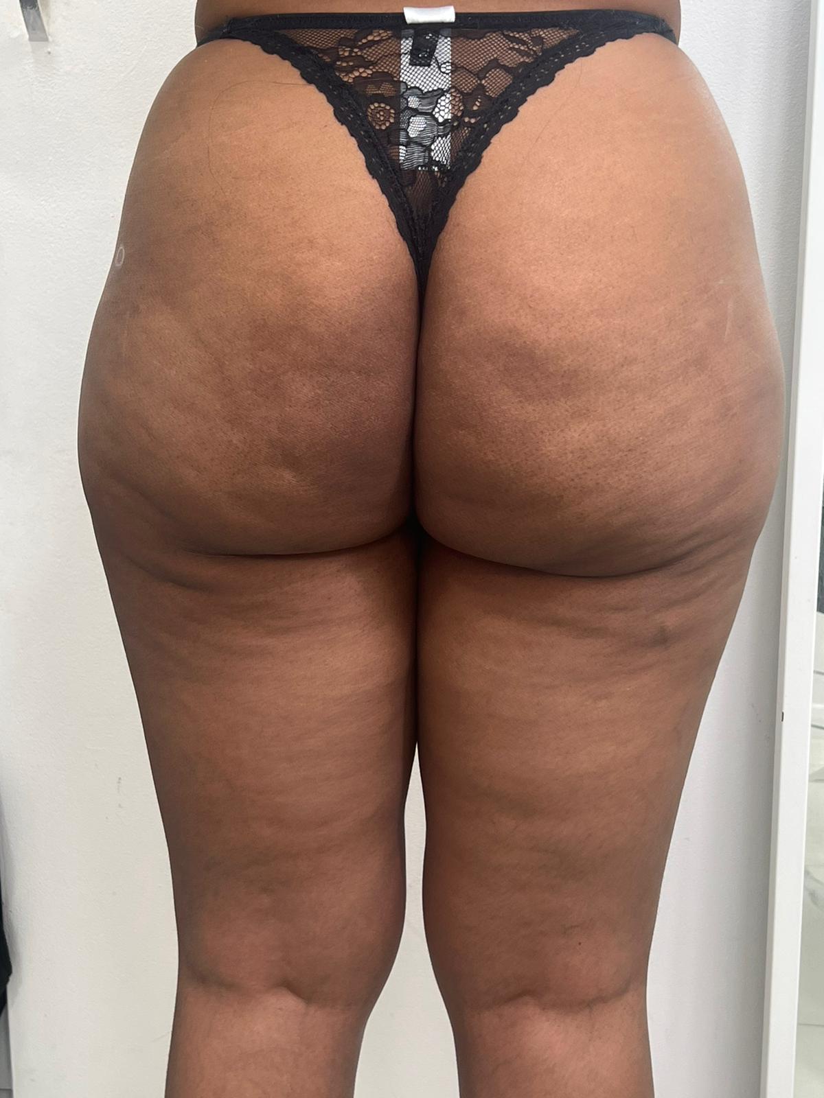 Liquid BBL | Non-Surgical Bum Lift Liquid BBL | Non-Surgical Bum Lift