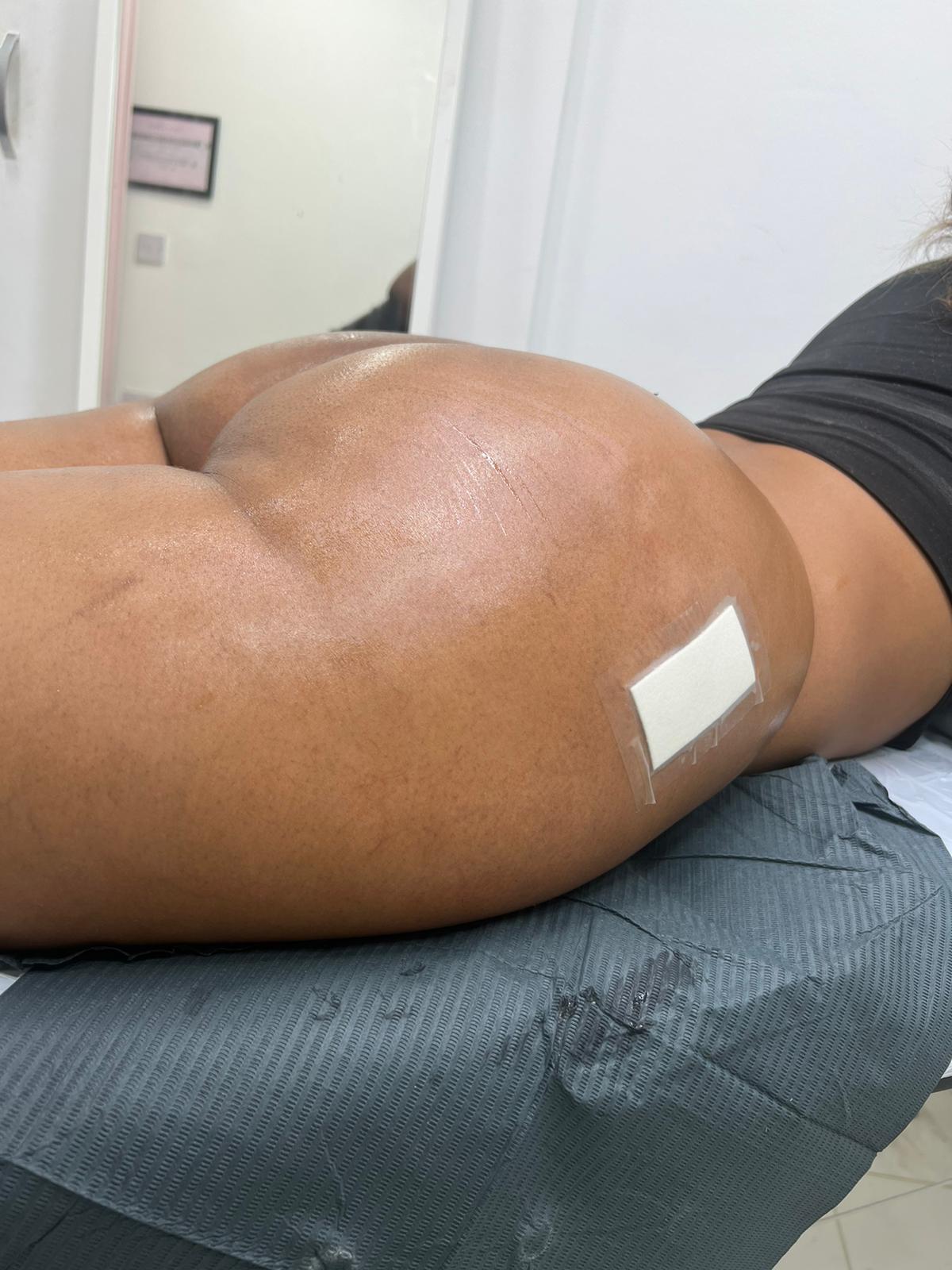 Liquid BBL | Non-Surgical Bum Lift Liquid BBL | Non-Surgical Bum Lift