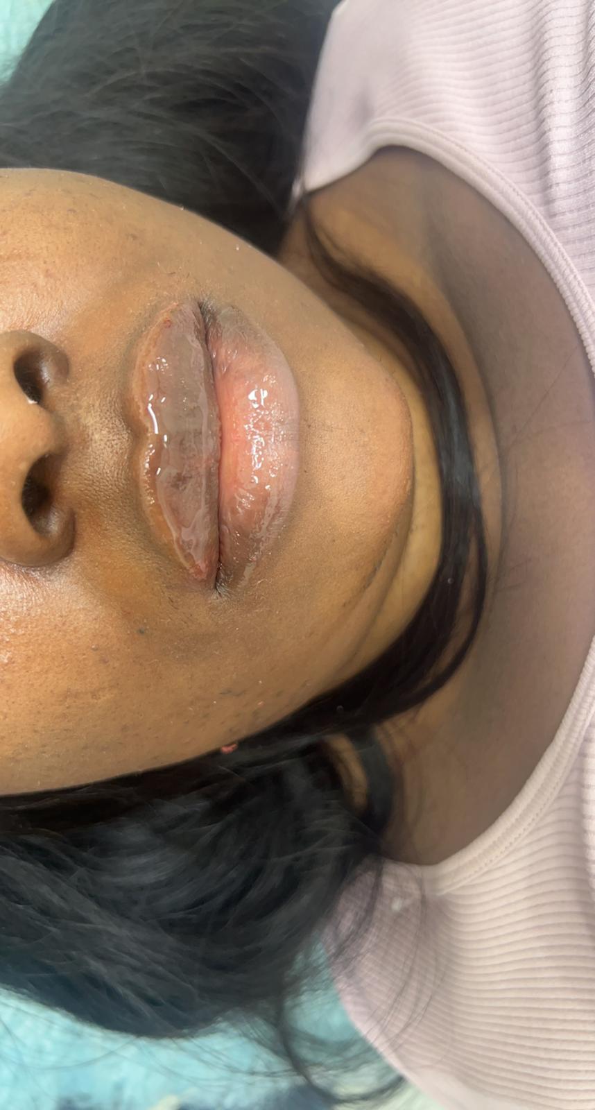 Dermal Fillers Dermal Fillers