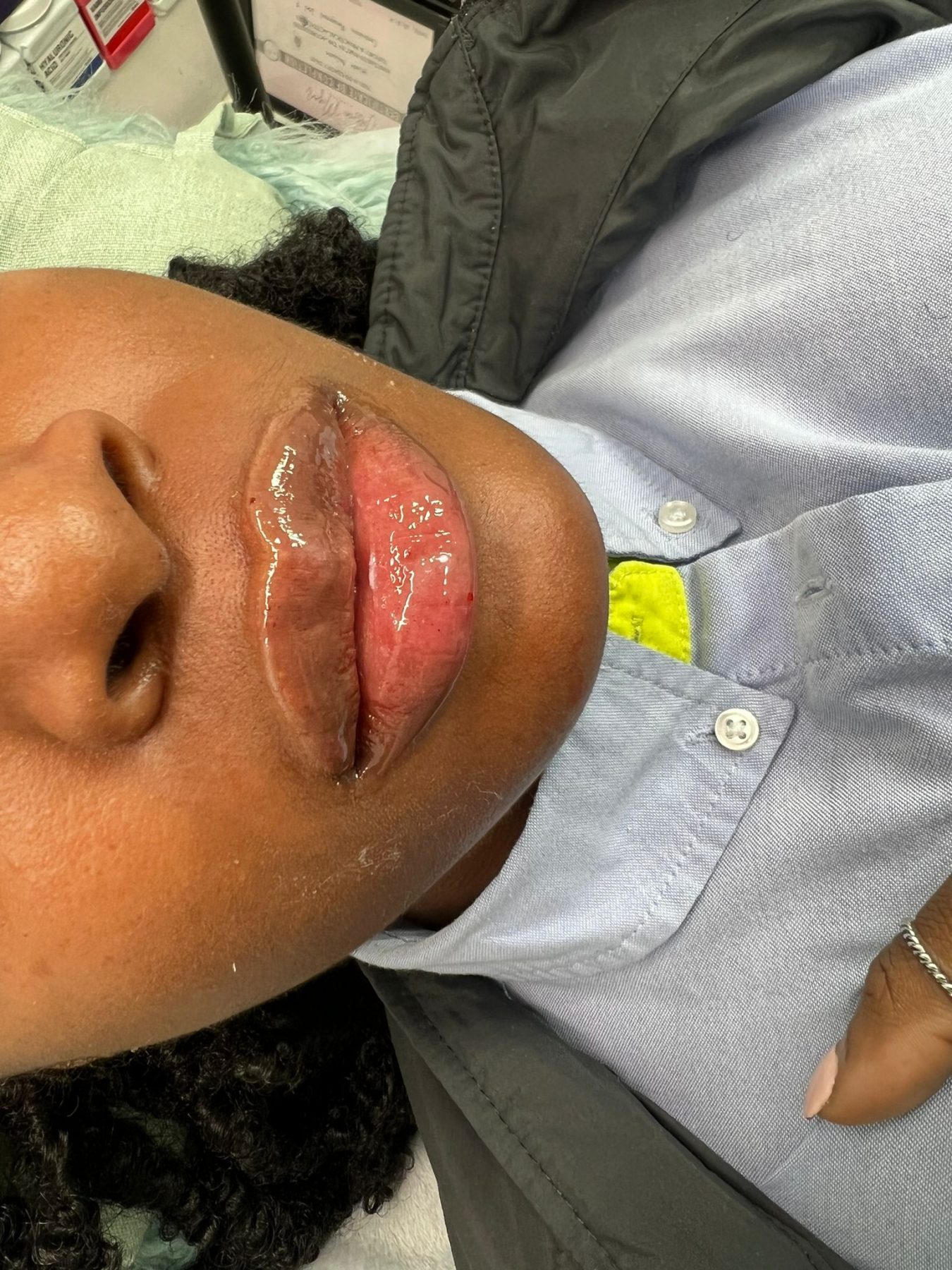 Dermal Fillers Dermal Fillers