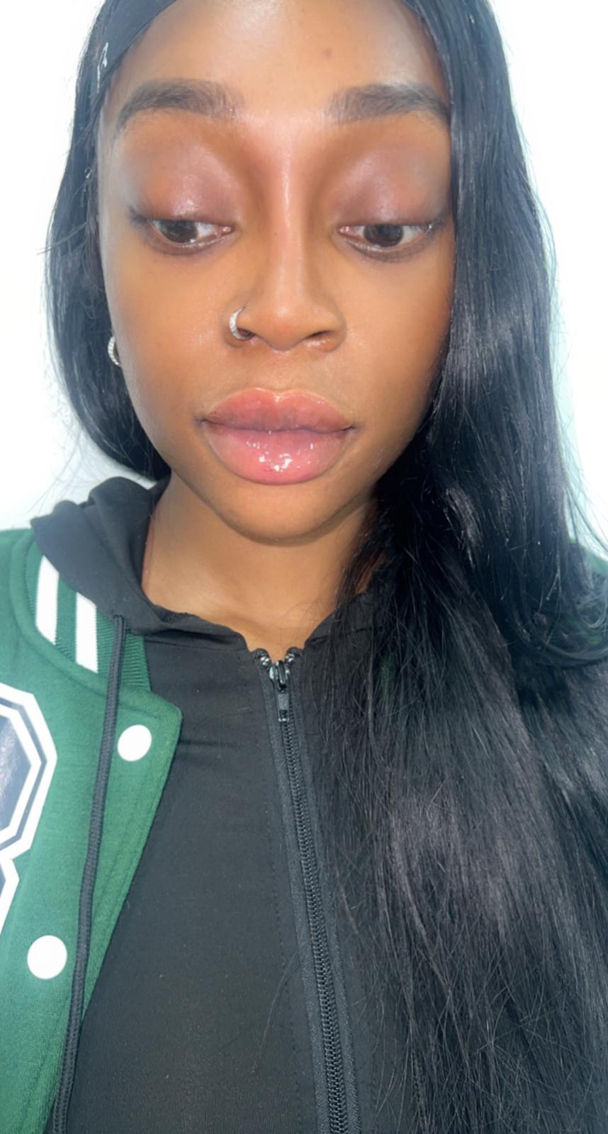 Dermal Fillers Dermal Fillers