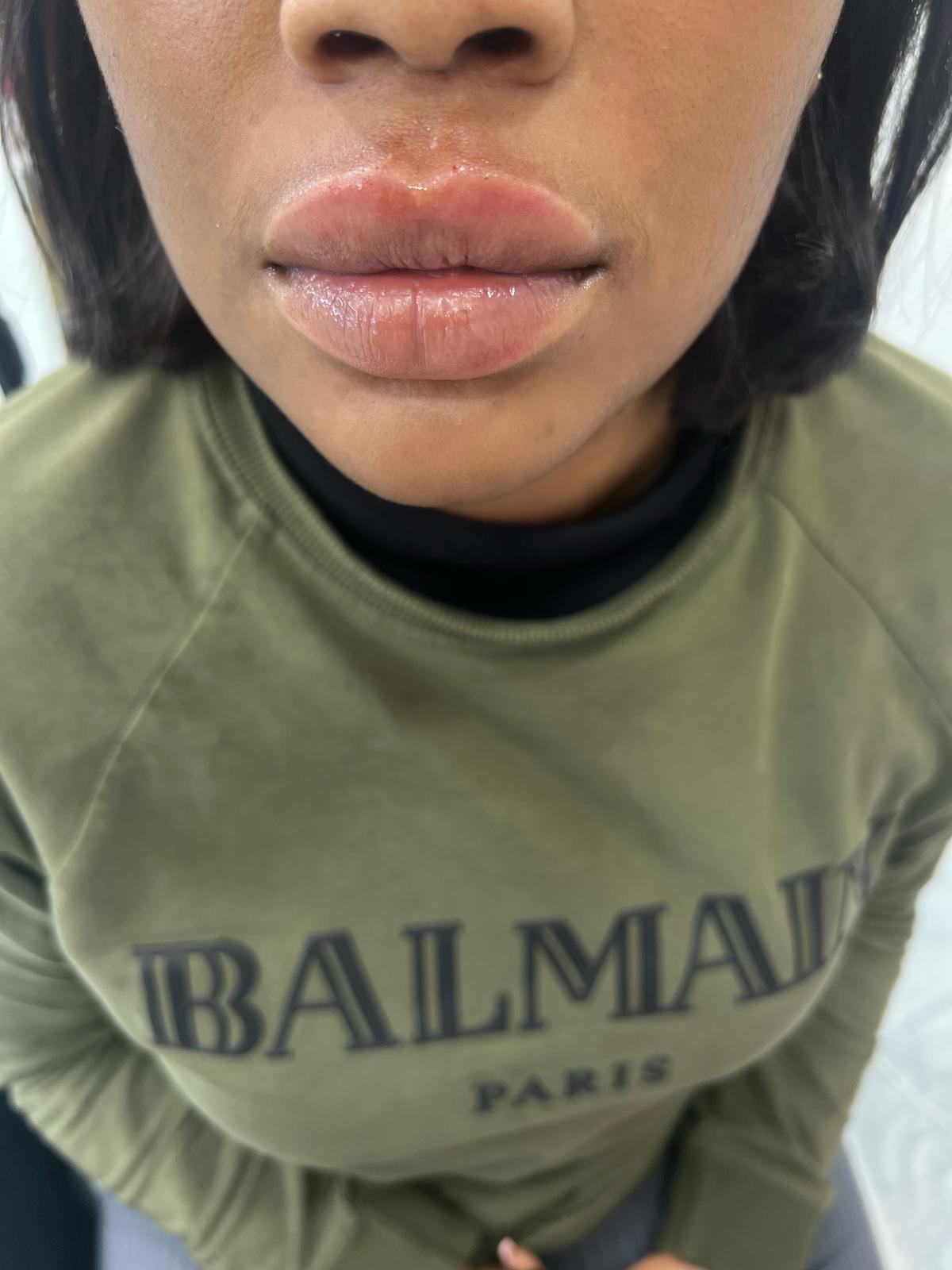 Dermal Fillers Dermal Fillers