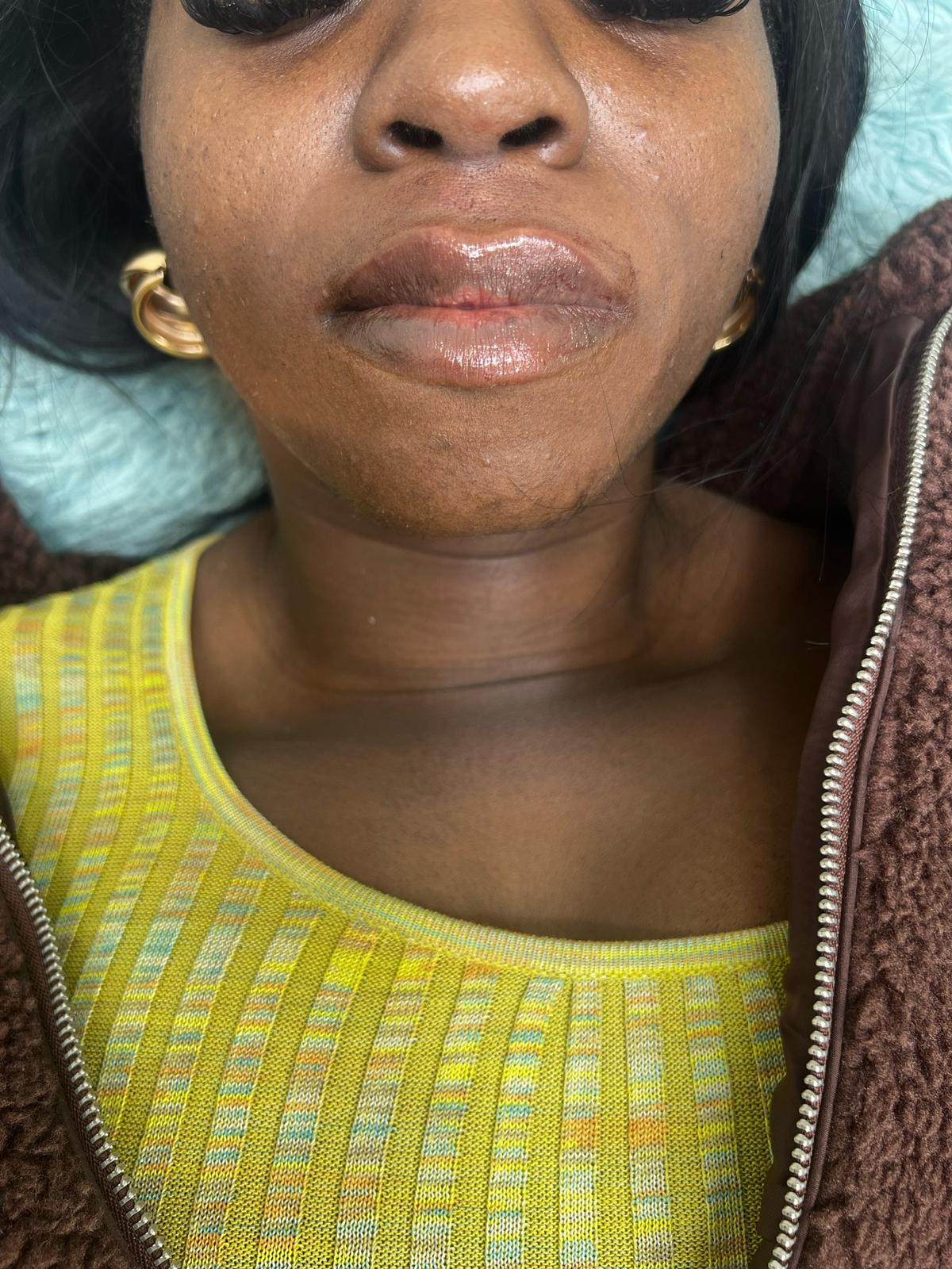 Dermal Fillers Dermal Fillers