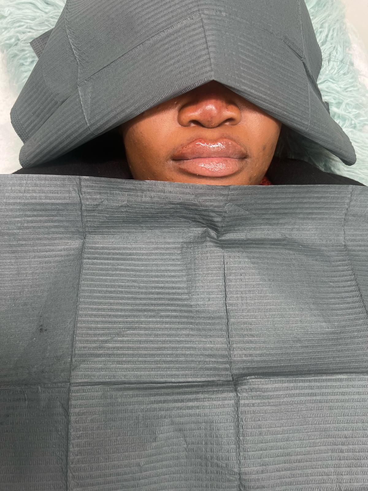 Dermal Fillers Dermal Fillers