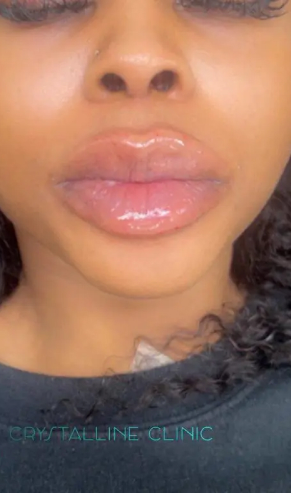 The best Guide to Dermal Fillers: all You Need to Know Before Your Appointment The best Guide to Dermal Fillers: all You Need to Know Before Your Appointment