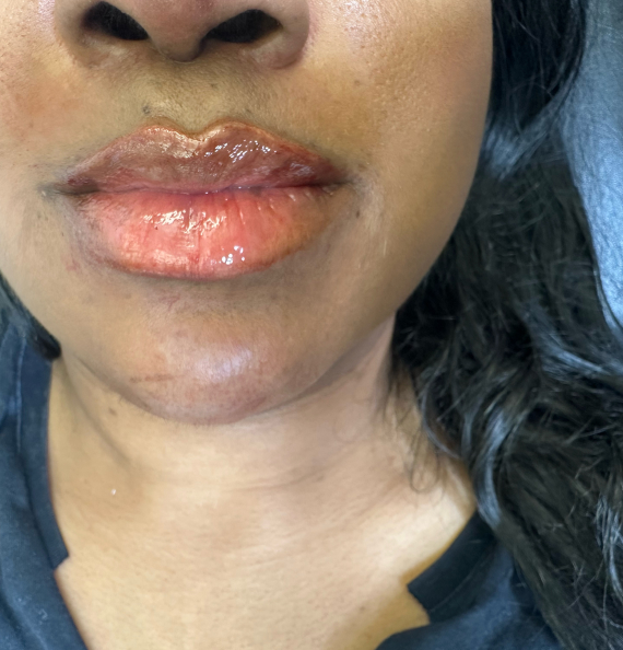 The best Guide to Dermal Fillers: all You Need to Know Before Your Appointment The best Guide to Dermal Fillers: all You Need to Know Before Your Appointment