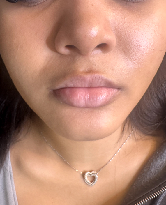 The best Guide to Dermal Fillers: all You Need to Know Before Your Appointment The best Guide to Dermal Fillers: all You Need to Know Before Your Appointment