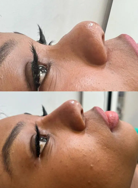 The best Guide to Dermal Fillers: all You Need to Know Before Your Appointment The best Guide to Dermal Fillers: all You Need to Know Before Your Appointment