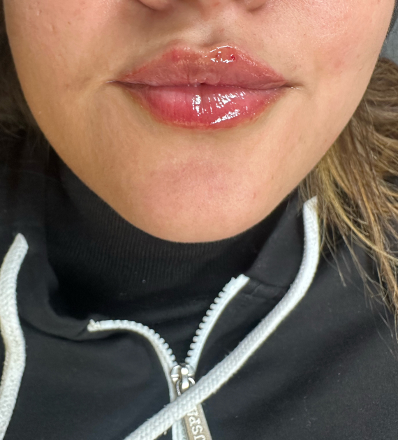 The best Guide to Dermal Fillers: all You Need to Know Before Your Appointment The best Guide to Dermal Fillers: all You Need to Know Before Your Appointment