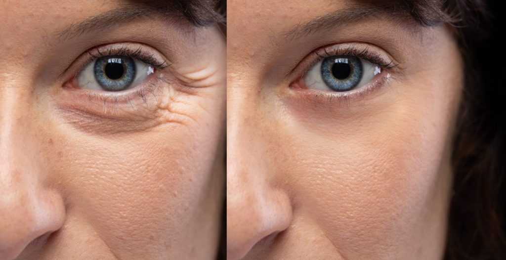 How Botox Can Help You Achieve a Youthful Glow Photo Comparison: 
Left - A woman prior to her Botox treatment with Wrinkles around her eye area
Right - A woman who has no wrinkles around her eye area due to her Botox treatment.
This is a demonstration of How Botox Can Help You Achieve a Youthful Glow