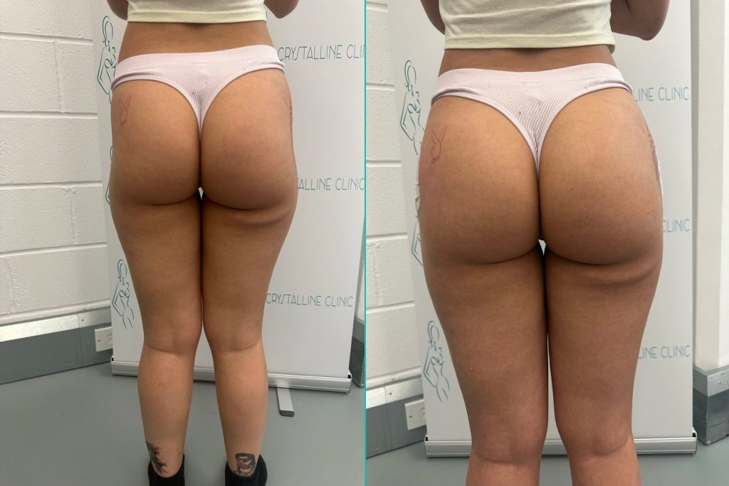 Revolutionary body sculpting. but How Long Do Liquid BBLs Last? Side by side comparison
Left - A womans buttocks with a hip dip prior to her liquid BBL.
Right - A womans buttocks after her liquid BBL with the hip dip gone.
But how long do liquid bbls last?